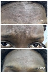 إزالة التجاعيد بالبوتكس